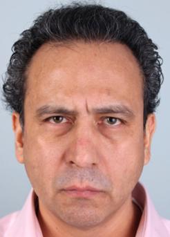 After Hair Transplant&nbsp;Front